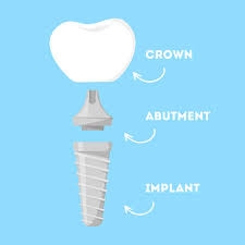 What is Behind Your Tooth Crown? 